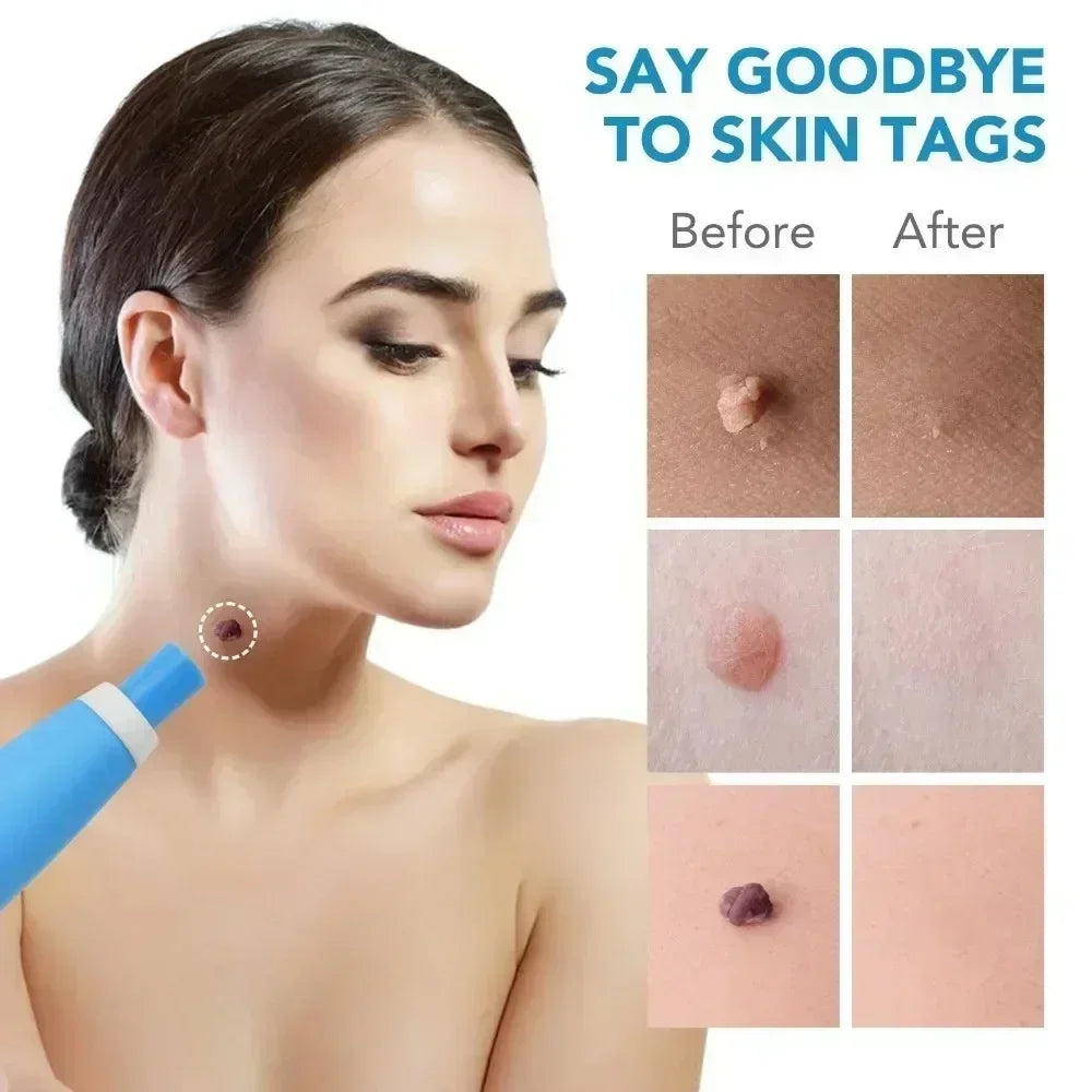 2-in-1 Skin Tag & Wart Removal Kit